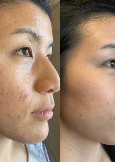 Bubble out Treatment for Acne