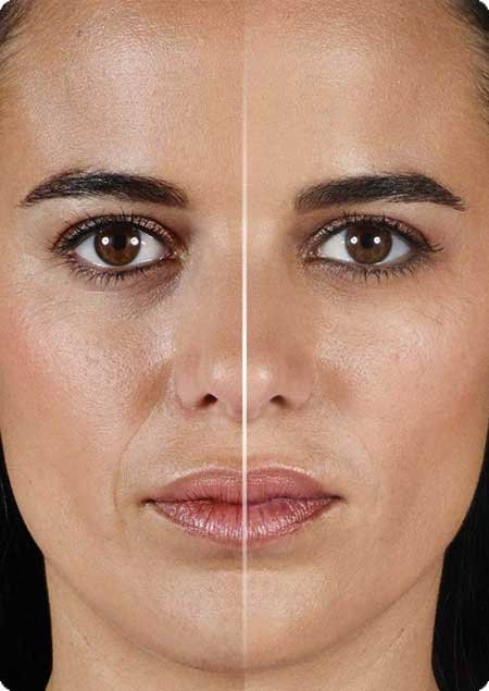 Dermal Fillers