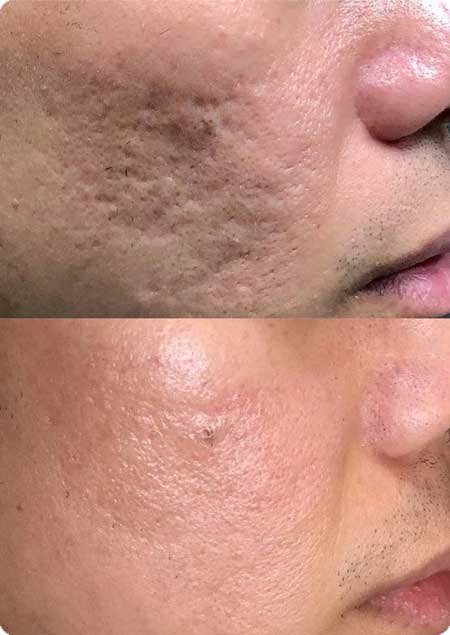 Laser Scars Removal