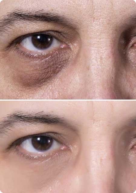 PRP for Under Eye Dark Circle