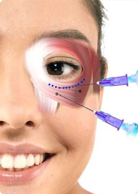 Thread for under eye dark circle