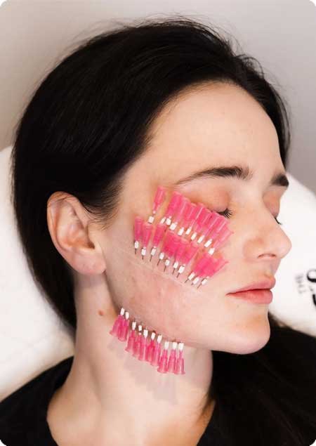 Bio Stimulantthread Lift skin rejuvenation