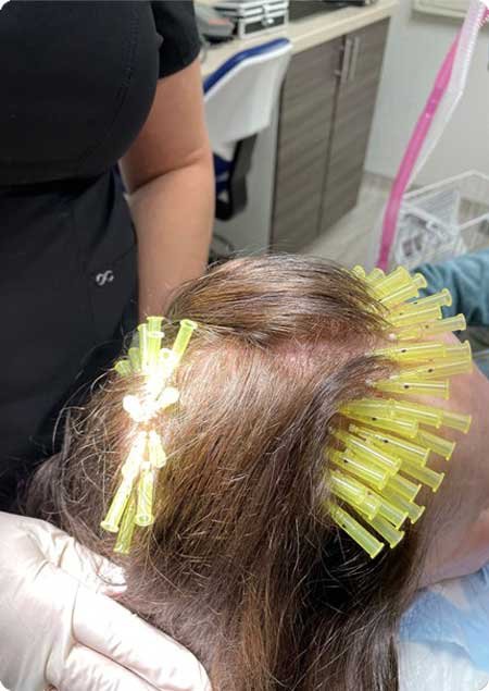 Bio Stimulant thread Hair for Restoration