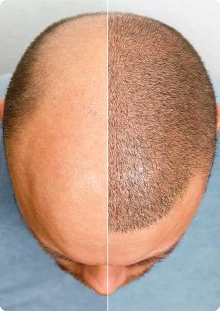 Hair Transplant
