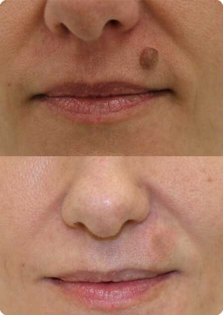 Laser Mole Removal