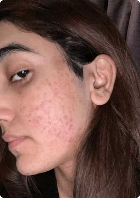 PRP for Acne Scars