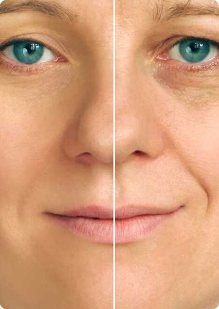 PRP for Wrinkles